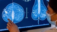 New 1-day surgery removes cancer and reconstructs the breast in the same operation