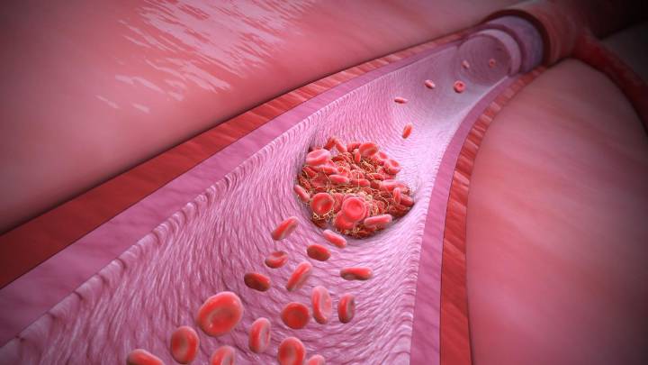 Trombosis: conoce cómo prevenir la enfermedad que mata una persona cada seis minutos
