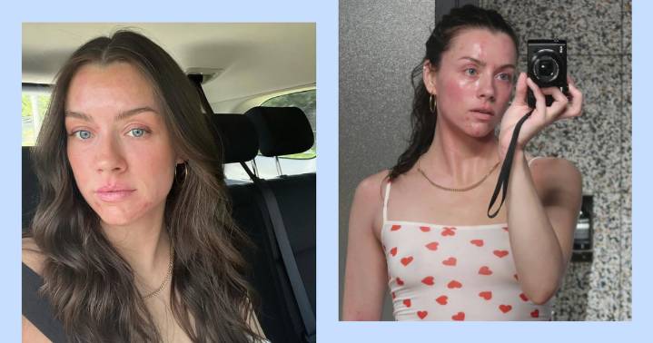 Influencer Madeleine Edwards on Understanding Her Eczema