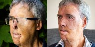 Un brutal accidente lo desfiguró, tuvieron que extirparle un ojo, pero una innovadora prótesis impresa en 3D le devolvió el rostro