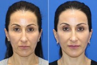Woman, 53, Let Her Plastic Surgeon Husband Perform Her Facelift 