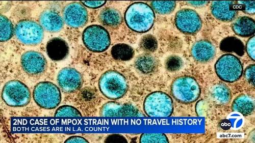2nd case of severe mpox strain confirmed in LA County patient with no travel history, officials say