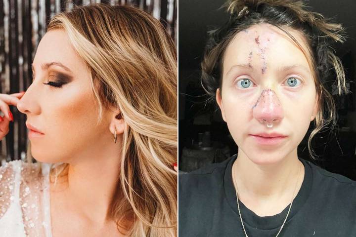 Dog Bites Woman's Nose 'Completely Off,' She Undergoes 4 Surgeries (Exclusive)