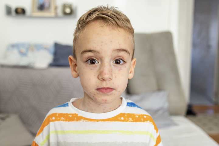 Can you get chickenpox twice? Or if you’re vaccinated? Experts answer 9 key questions