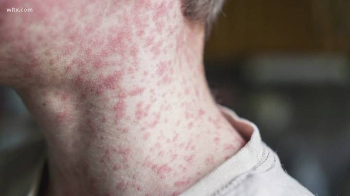 Is South Carolina dealing with a measles outbreak in the Upstate?