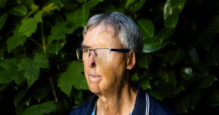 Man gets new 3D-printed face after near-death experience as he's 'lucky to survive'
