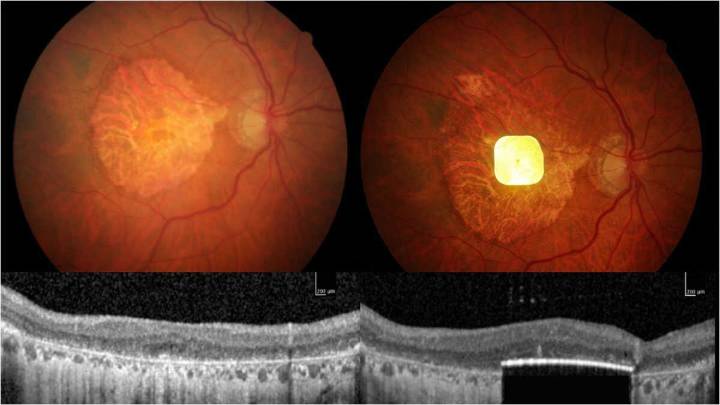 Una nueva prótesis ocular devuelve la visión a pacientes con ceguera irreversible