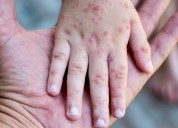 Otoño, época con más casos del mal de mano