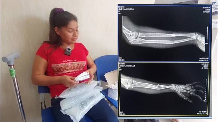 Tarapoto: Adolescente sufre fracturas en ambos brazos tras caer en montículo de construcción dentro de colegio en Picota