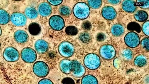 Possible local mpox spread investigated after 3 cases with no travel history reported