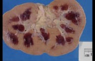 Acute Kidney Injury in CCU Patients Increases Mortality and Hospital Stay: Study