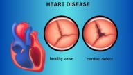 TCT 2025: PREVUE-VALVE Study Indicates Burden of Valvular Heart Disease in Adults Aged 65