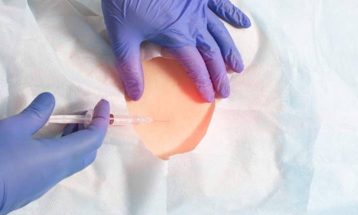 Epidural Analgesia Lowers Risk of Severe Perineal Tears in First