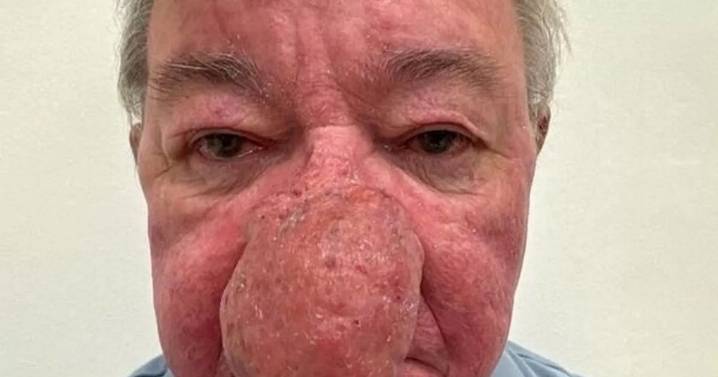 Scottish grandad unable to kiss wife for years due to continuously growing nose