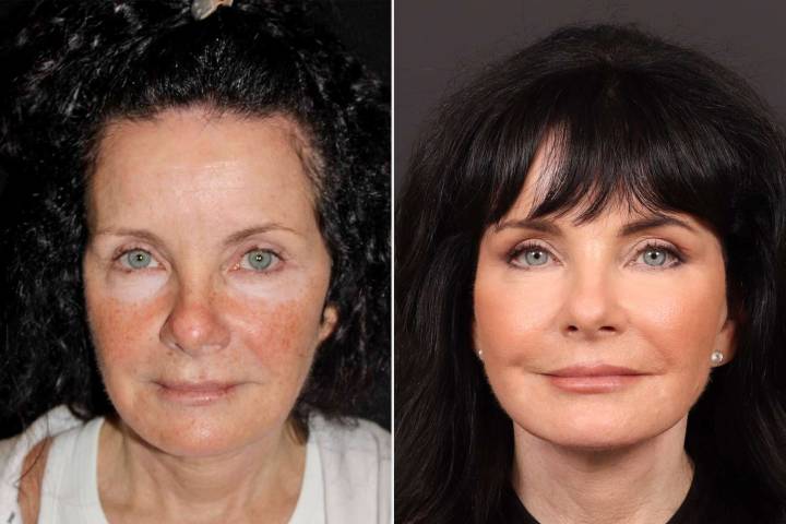 Woman, 65, Gets Plastic Surgery to Address 'Turkey Neck' — Before