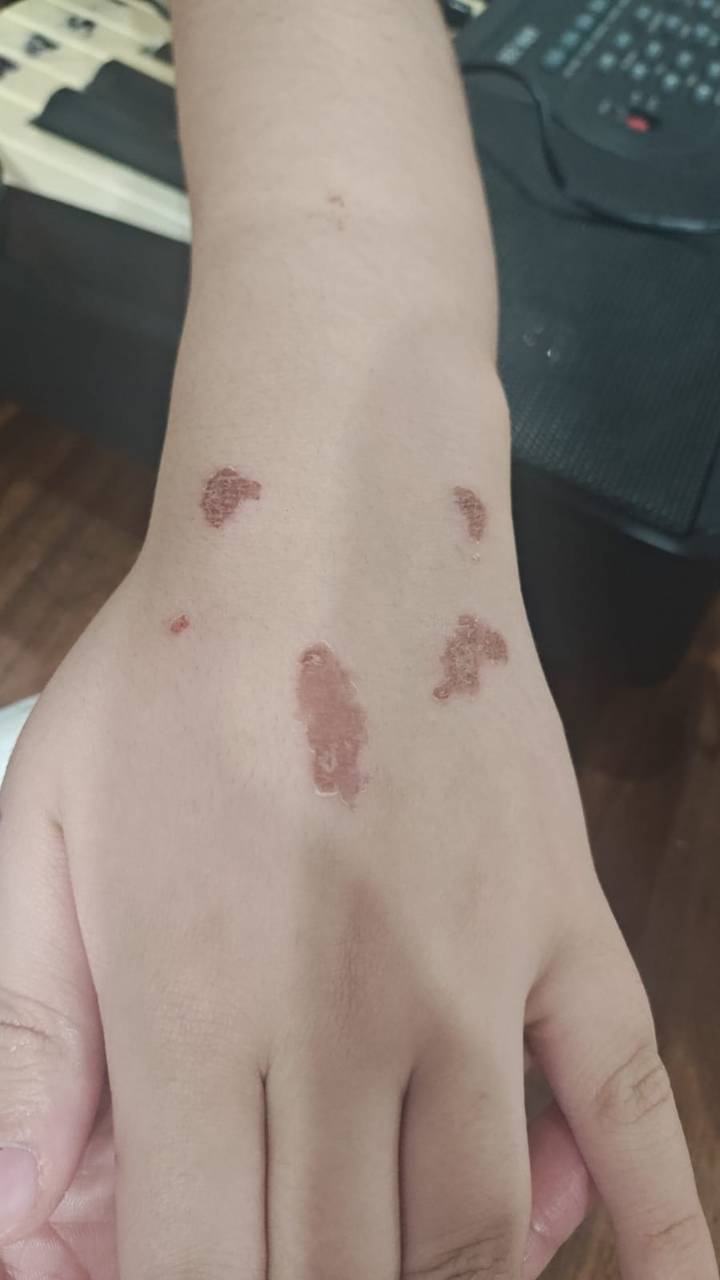 Una niña sufrió quemaduras por glitter: denuncian falta de control nacional
