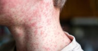 Minnesota's measles case count jumps to 20, with most unvaccinated children