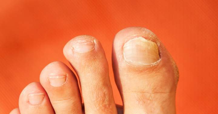 10K toenail clippings needed for Canadian study on potential lung cancer risk