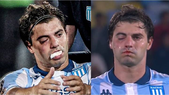 Preocupación en Racing: Santiago Sosa tiene fractura de maxilar por el golpe de Marcos Rojo y es duda para la revancha ante Flamengo