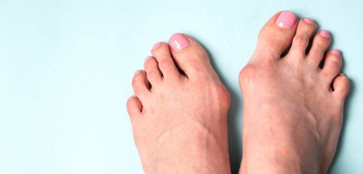 ¿Por qué aparecen los juanetes? Si ya los tienes, no sucumbas; si no, puedes prevenirlos