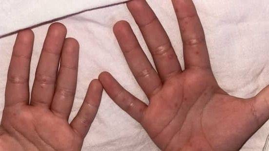 Todo lo que debes saber sobre el virus de manos, pies y boca