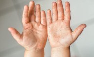 Coxsackie: el virus de las guarderías que se puede prevenir