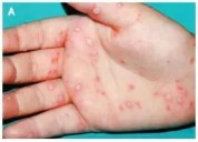 CONFIRMAN 165 CASOS REPORTADOS: Asegura la secretaria de Educación, Elda Xix, que  brote del virus coxsackie detectado en los municipios de Tulum, Bacalar y Othón P. Blanco se logró controlar