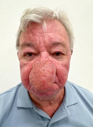 Man undergoes life-changing surgery for massive nose growth