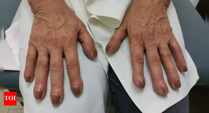Lung cancer symptoms on fingers: Finger clubbing, nail changes and other warning signs that could indicate serious health risks