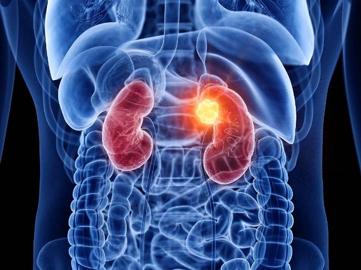 Global Burden of Renal Cancer Expected to Double by 2050
