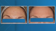 'Risk of having true catastrophe' | Louisiana health officials warn against counterfeit Botox, unlicensed injectors