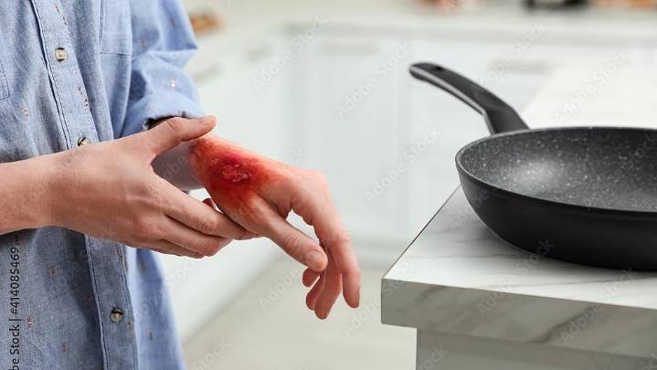 MP News: Woman Burnt With Hot Iron By In-Laws In Jabalpur; Tortured With Constant Taunts About Past Marriage