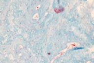 Novel CLIC5 Gene Therapy Uses AAV Technology to Treat Hearing Loss