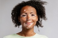 ICD-10 Code L80 Accurately Identifies Vitiligo