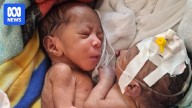 Conjoined boys born in PNG bound for Australia for medical treatment
