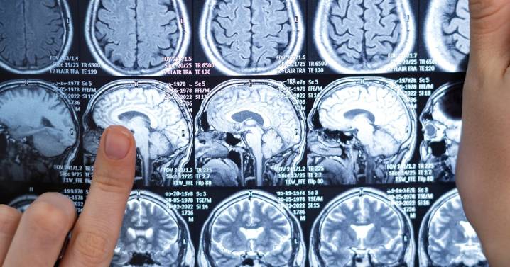 Detectar a tiempo los síntomas del Ictus es fundamental para salvar vidas: Ssa