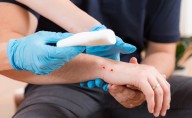 ¿Qué riesgos corres tras una mordida de animal?