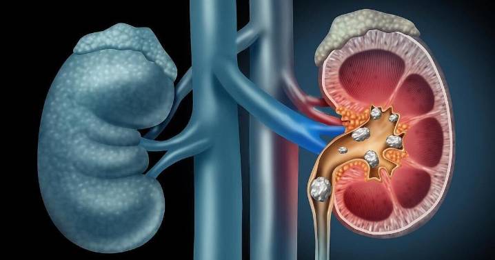 Shift Workers Face Higher Risk For Kidney Stones