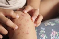 Autoridades confirman dos casos del virus Coxsackie en una escuela de Hidalgo