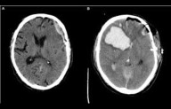 Surgical and Conservative Approaches have Comparable Outcomes in patients with acute subdural...