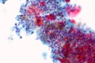 ‘Incredibly Encouraging’ Drug Trial Shrinks Tumors in Head and Neck Cancer Patients Within Six Weeks