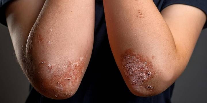 El divorcio y la separación podrían aumentar el riesgo de psoriasis en los niños