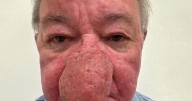 Scottish grandad unable to kiss wife for years due to continuously growing nose