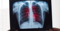 Un modelo de IA estima el riesgo de cáncer de los nódulos pulmonares