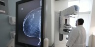 Lobular breast cancer on the rise