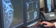 UW School of Medicine joins study of AI use in breast cancer screening