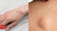 Cysts vs. Tumours: How to tell the difference between harmless and dangerous lumps