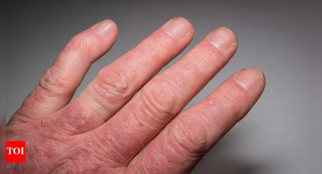 What is Psoriatic Arthritis: Know its signs, causes, and how to manage