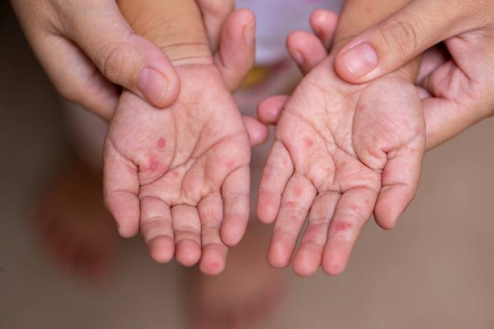 Crisis sanitaria escolar: SEP Puebla suspende clases tras contagios de virus Coxsackie
