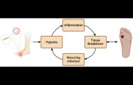 Activated PRP Plus Angioplasty Enhances Healing in Diabetic Foot Ulcers, suggests study